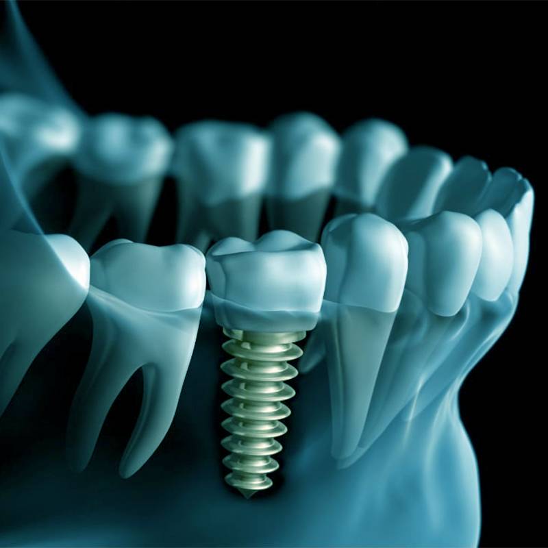 dentista genova tiraoro Implantologia