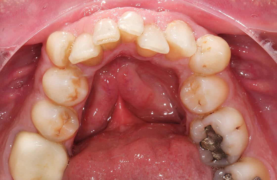dentista genova tiraoro Ortodonzia linguale